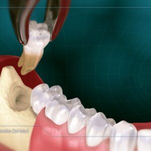 568 Wisdom teeth removal