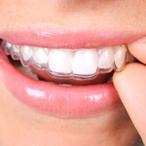 Aligner Clear Dental Aligners on Teeth